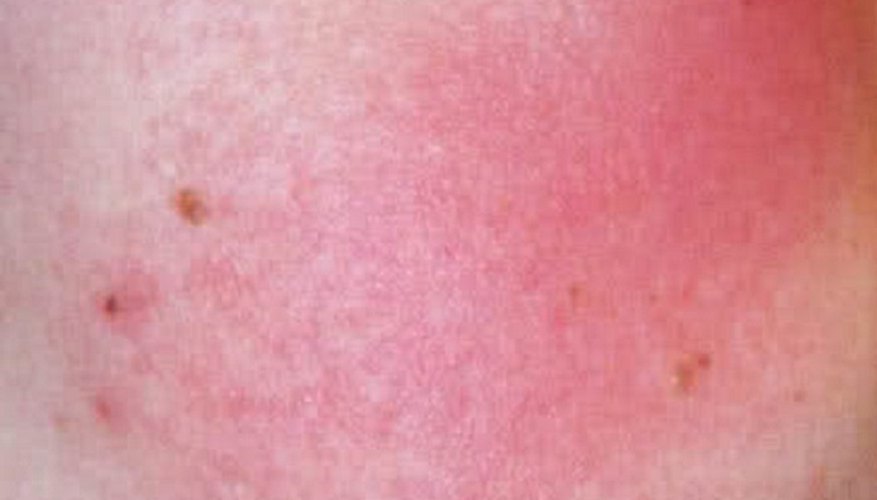 Keratosis pilaris rubra faceii causes a reddening of the cheeks.